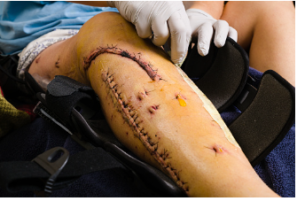 Image shows physical traumatic injury which can cause body dysmorphia or feeling unhappy in your skin. Loving yourself can be hard when your body has changed physically.

In order to be truly happy, you must do what you need to do for yourself, unapologetically. Individual therapy is offered at our Woodland Hills, CA therapy practice. 91364 | 91307 | 91356