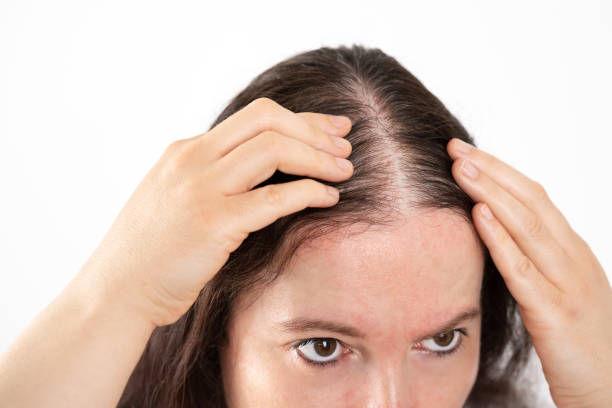 In this image, a woman is looking at her hairline. She is examining her head to see if there are any signs of hair loss.